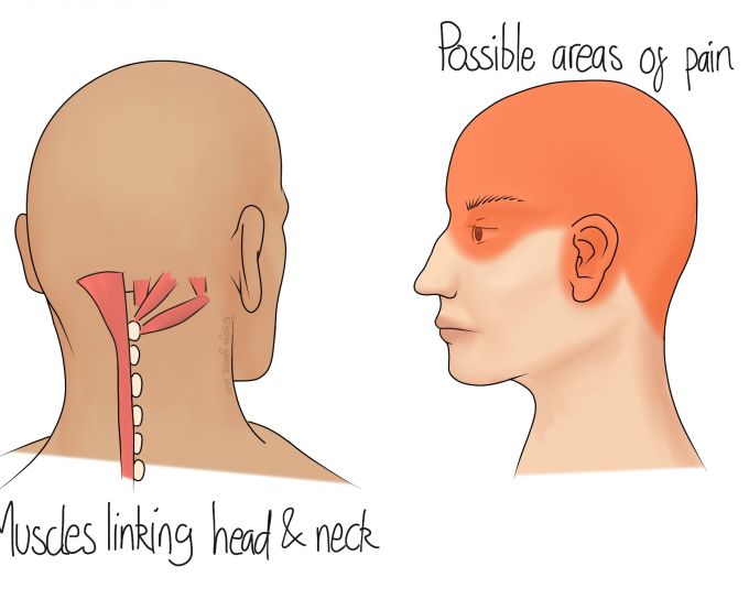 Cervicogenic Headaches