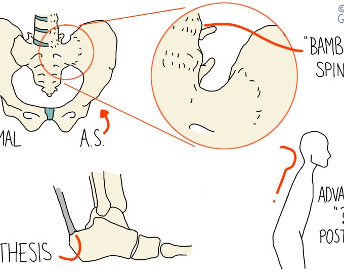 AxSpA & Ankylosing Spondylitis