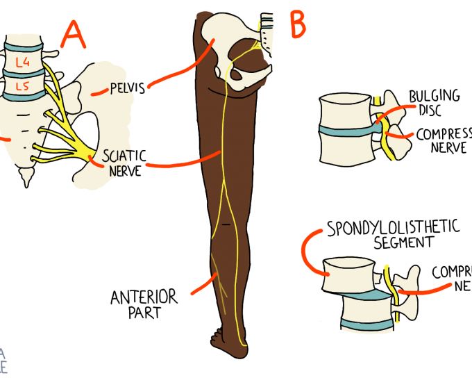 Sciatica