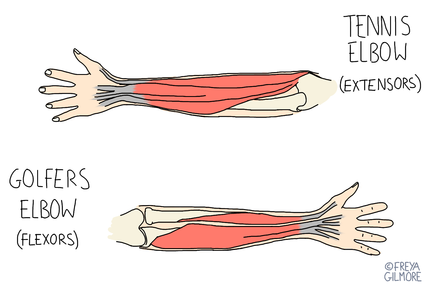 Anatomy affected in Tennis Elbow and Golfers Elbow