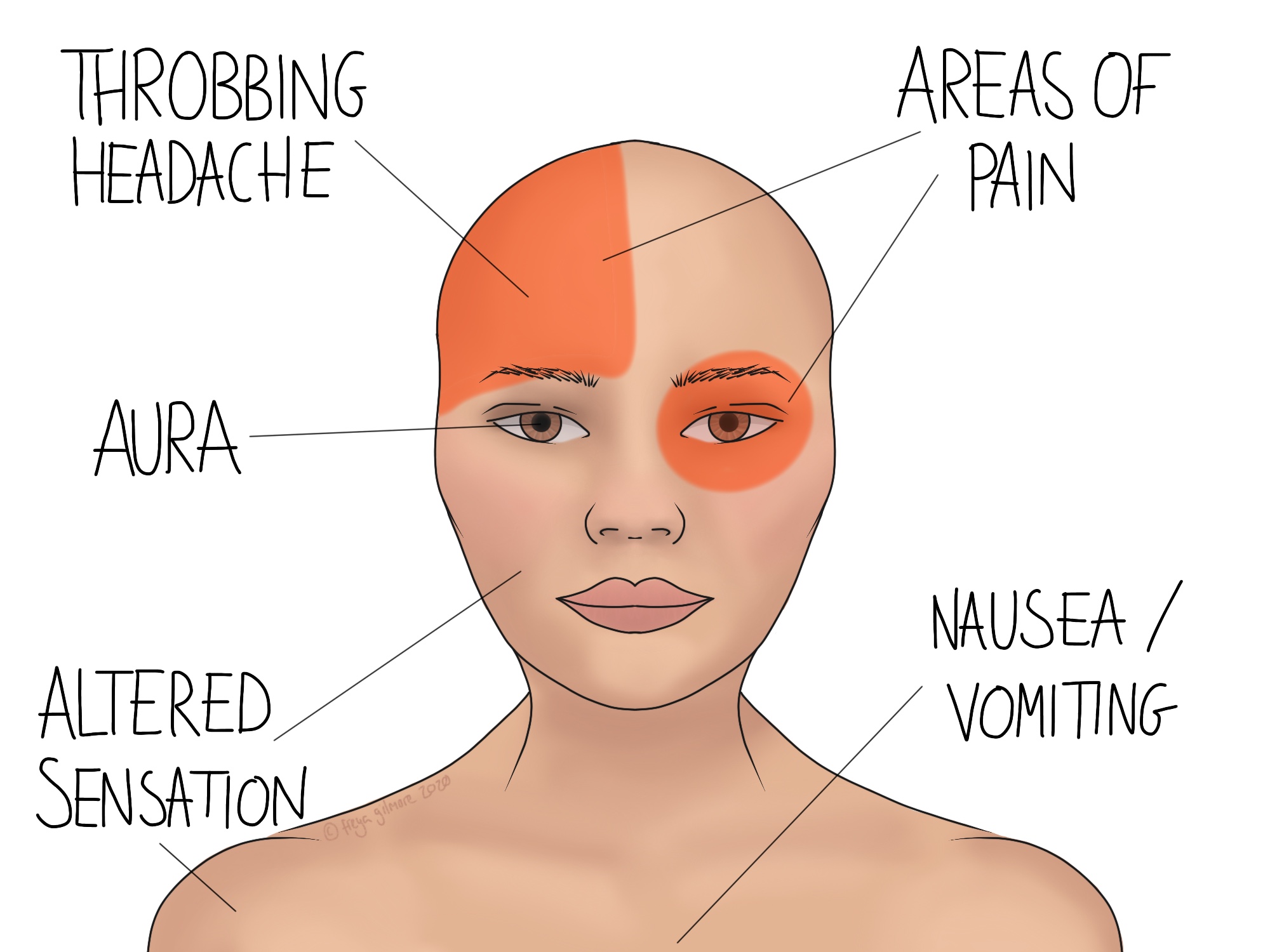 Symptoms of a migraine