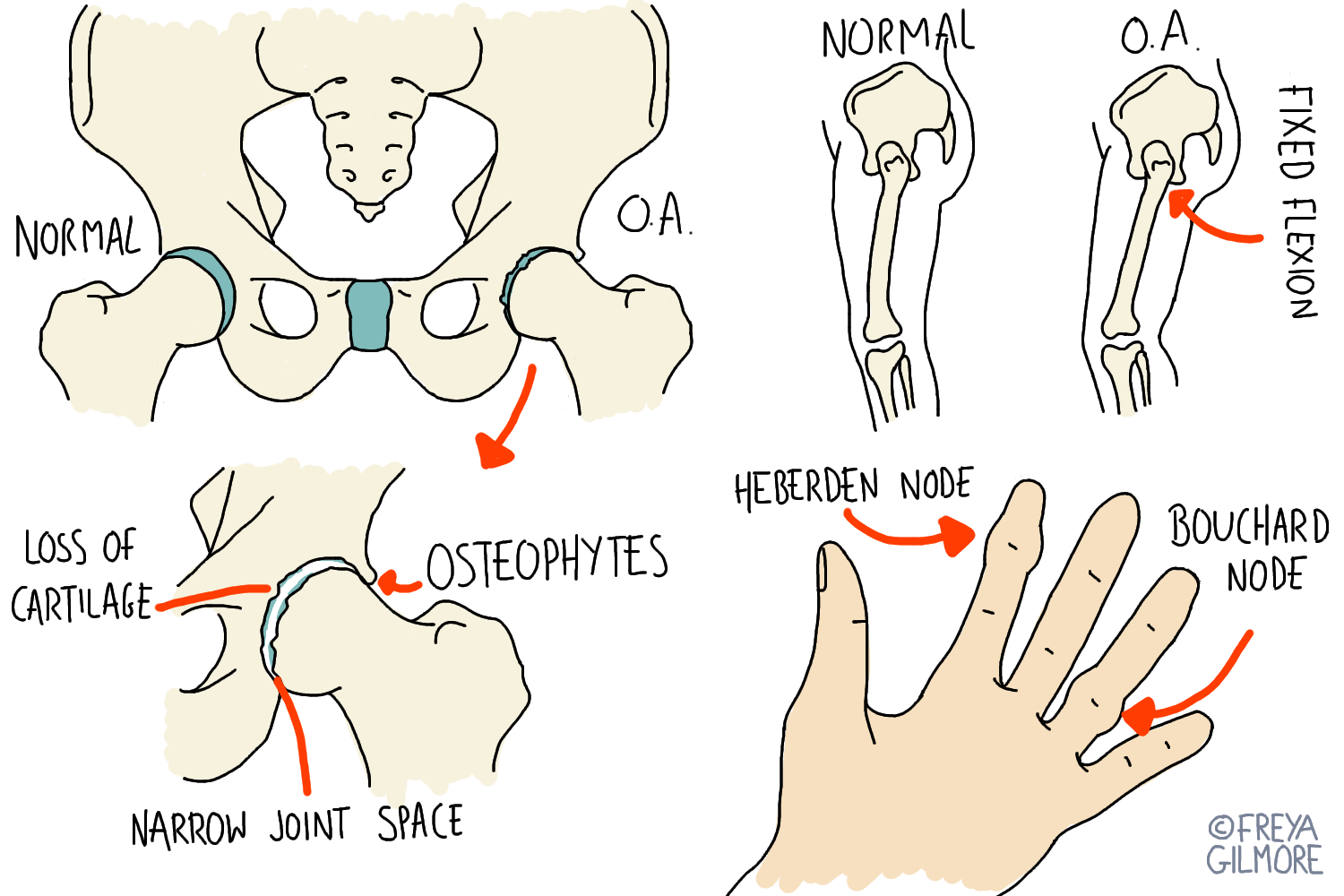 Osteoarthritis: a cause of joint pains