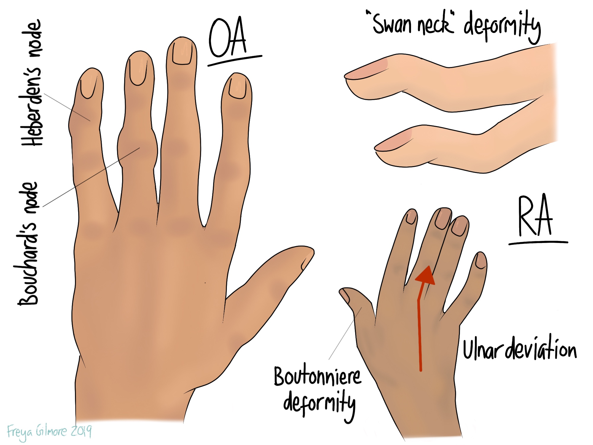 Hand symptoms of rheumatoid arthritis